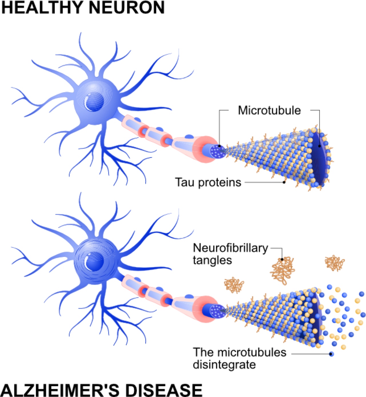 alzheimer çalışması