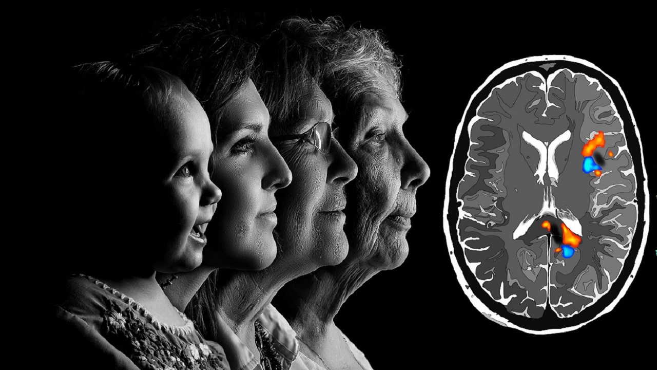 Kronik Stres Alzheimer'n Sebeplerinden Biri Olabilir