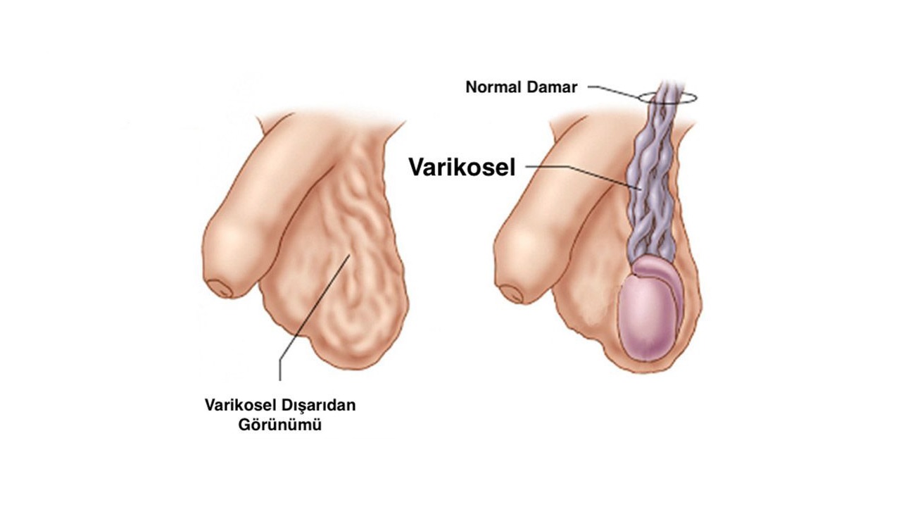 Çoğu Zaman Semptom Göstermeyen Ancak Ciddi Sorunlara Yol Açabilen ’Varikosel’ Nedir, Neden Olur? Belirtileri ve Tedavi Yöntemleri