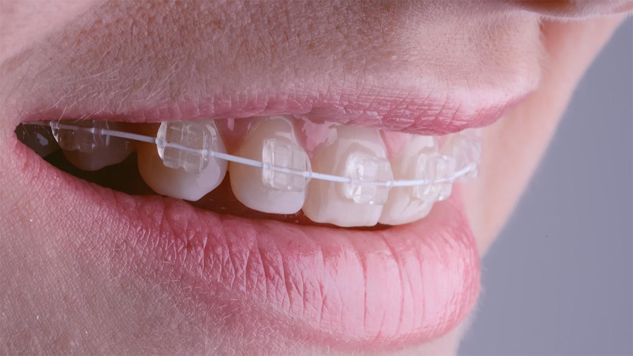plastic braces