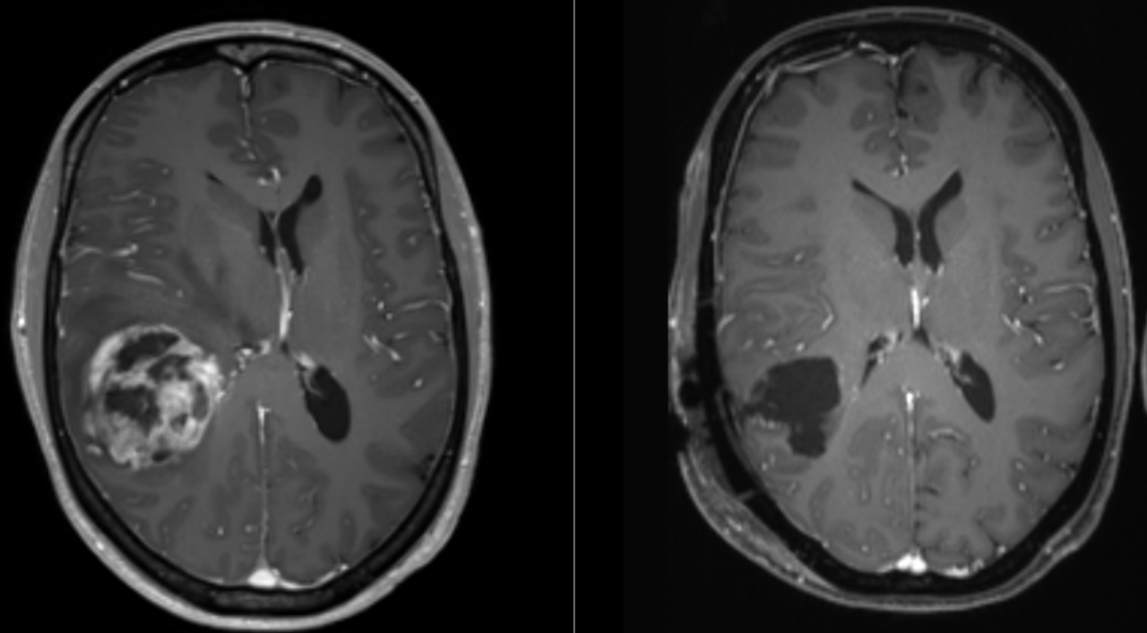 glioblastoma